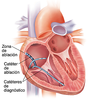 Ablación cardíaca
