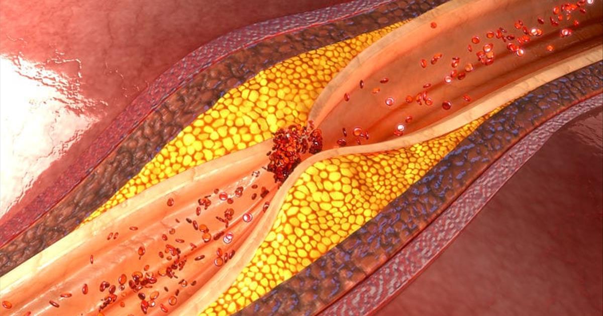 ateromatosis intracraneal 