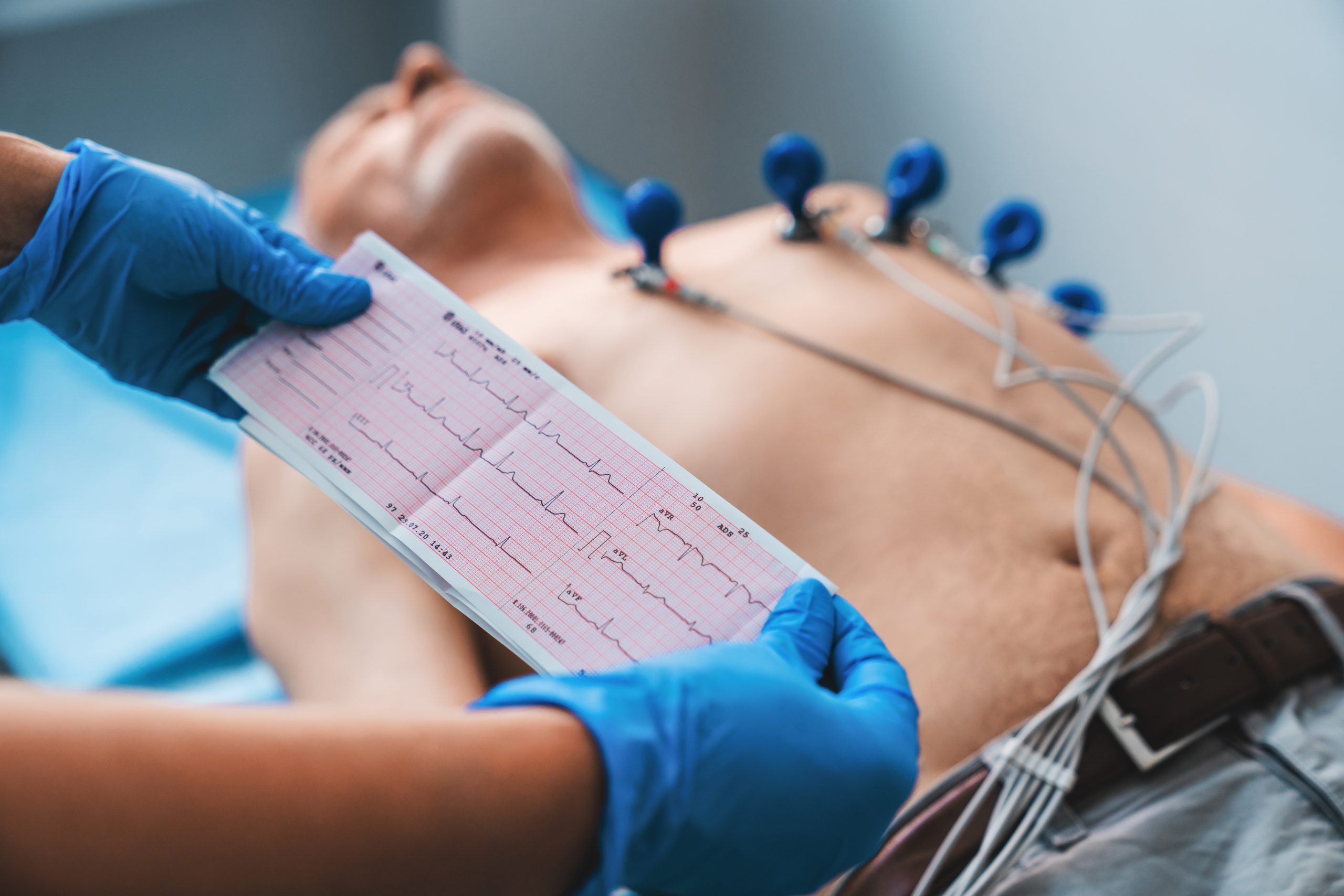 Electrocardiograma y ACV: la influencia de la hipertensión
