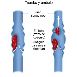 Émbolo y trombo