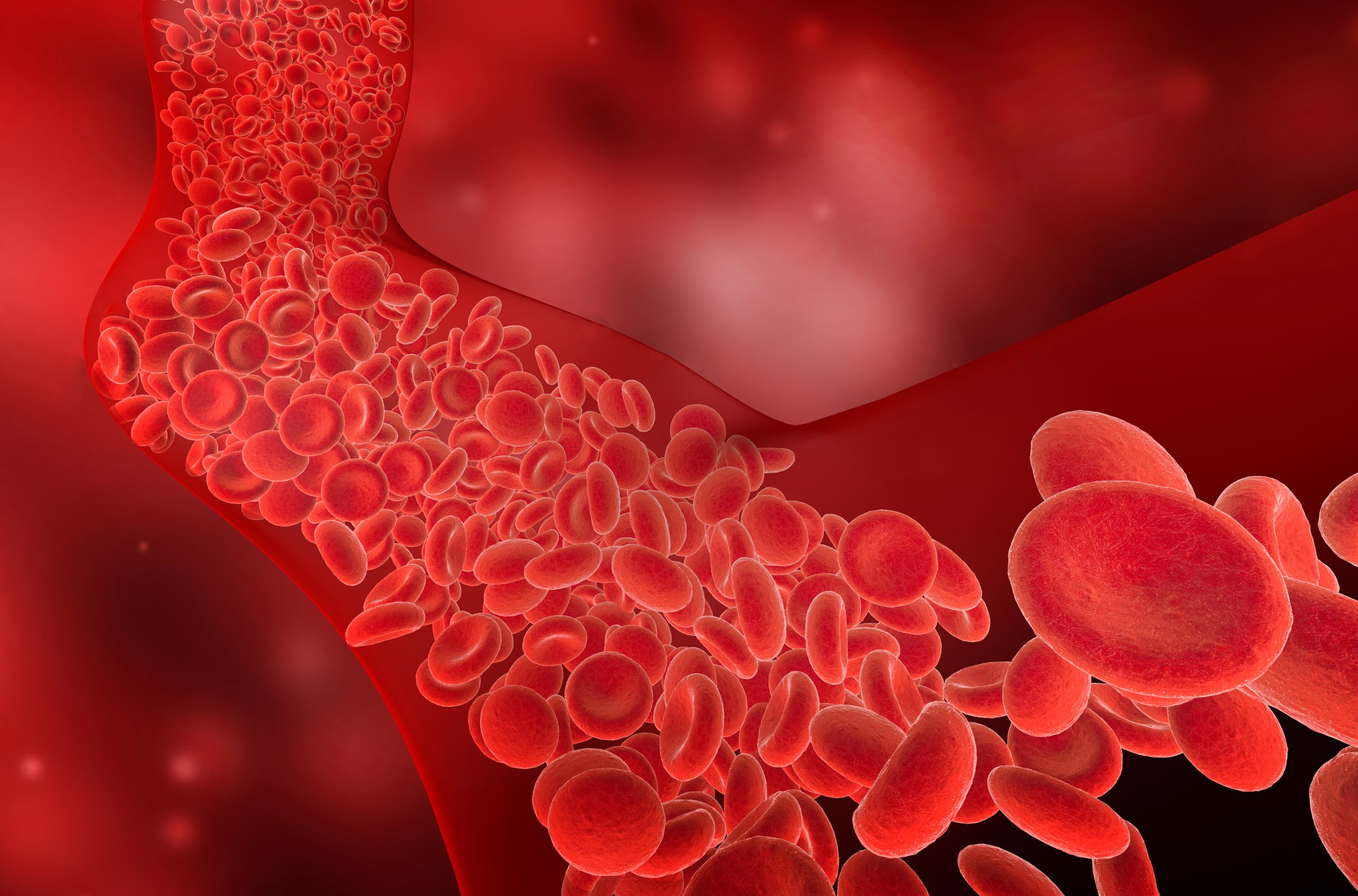 Trombosis venosa profunda y ACV: Riesgos de coágulos sanguíneos