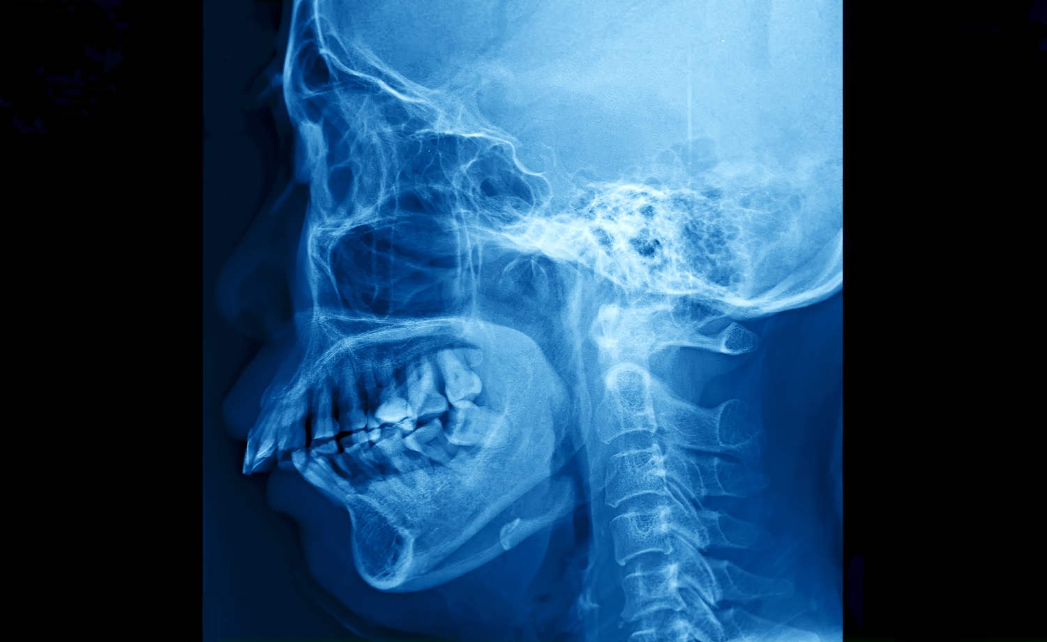 Disección arterial cervical