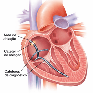 Ablação cardíaca