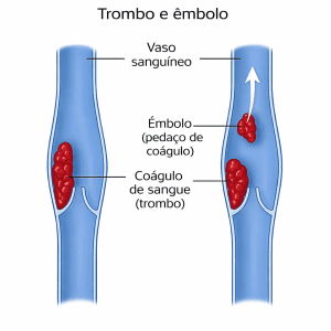 Êmbolo e trombo: diferenças, causas e sua relação com o acidente cerebrovascular 2 Êmbolo e trombo