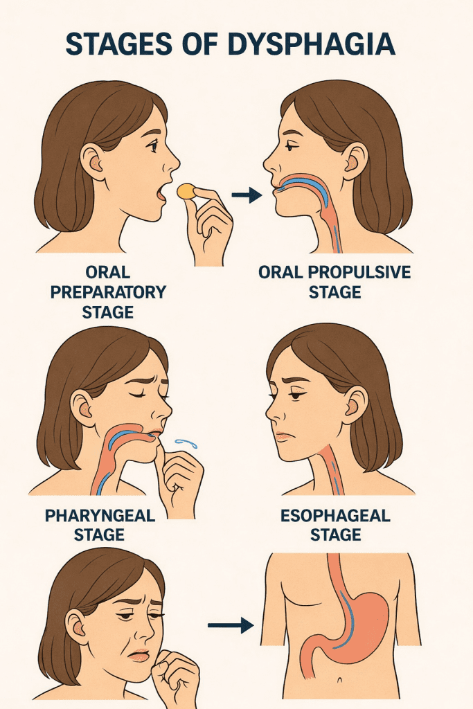 stages of dysphagia