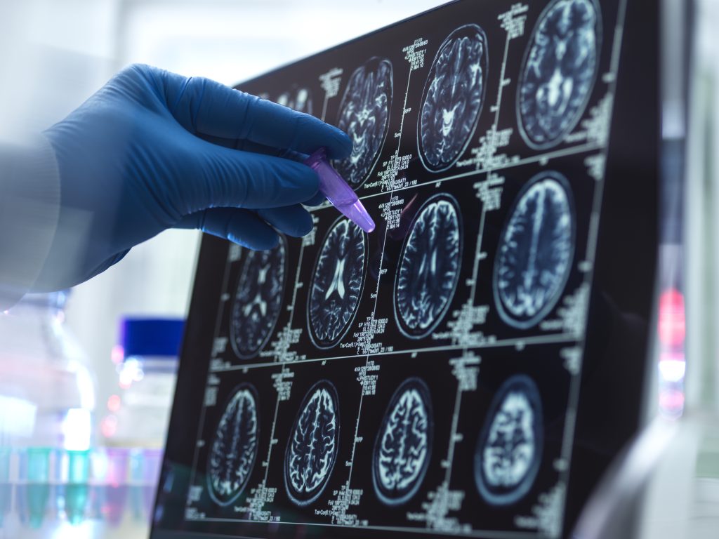 Arteria cerebral media
