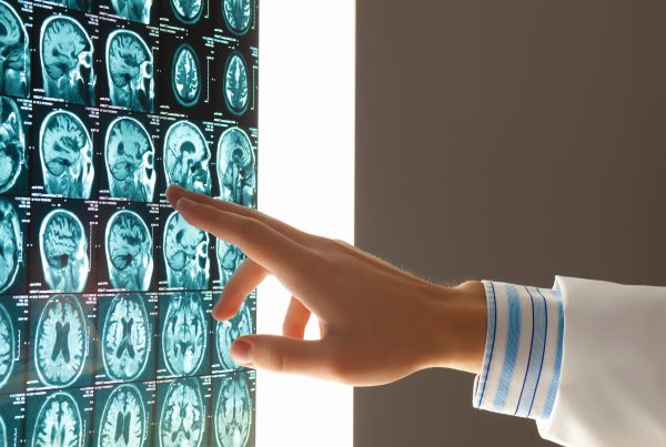 Arteria cerebral media