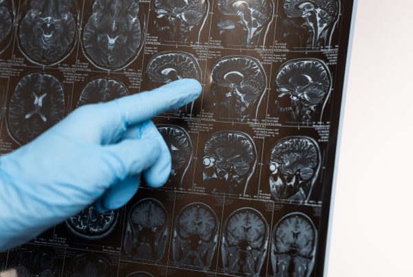 Cápsula interna del cerebro: funciones y síntomas 6 Cápsula interna del cerebro