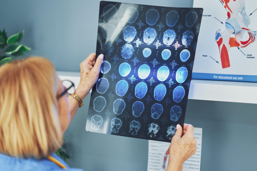 Cómo prevenir un segundo derrame cerebral