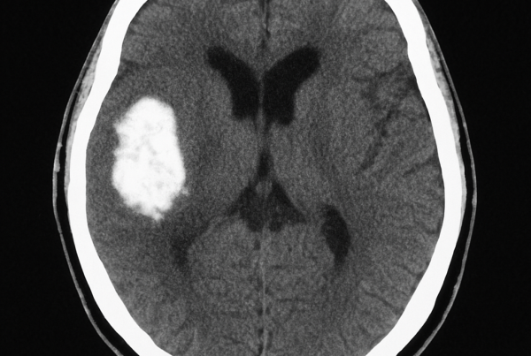 Cuáles son los cuatro tipos de hemorragia cerebral 12 Cuáles son los cuatro tipos de hemorragia cerebral