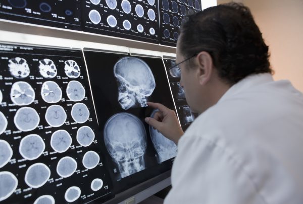 Hemorragia lobar: cuando el sangrado afecta los lóbulos del cerebro 3 Hemorragia lobar