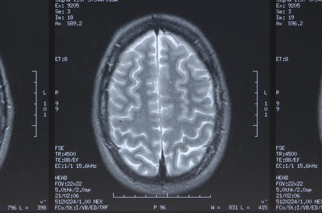 Ictus criptogénico