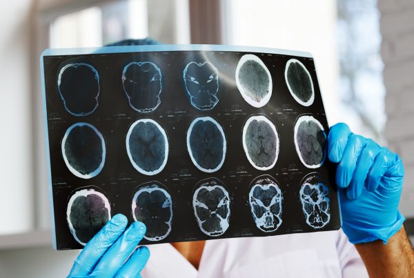 Infarto del tronco encefálico: pequeña lesión puede cambiarlo todo 3 Infarto del tronco encefálico