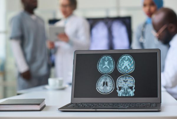 Infarto vertebrobasilar: tras un acv de la circulación posterior 7 Infarto vertebrobasilar