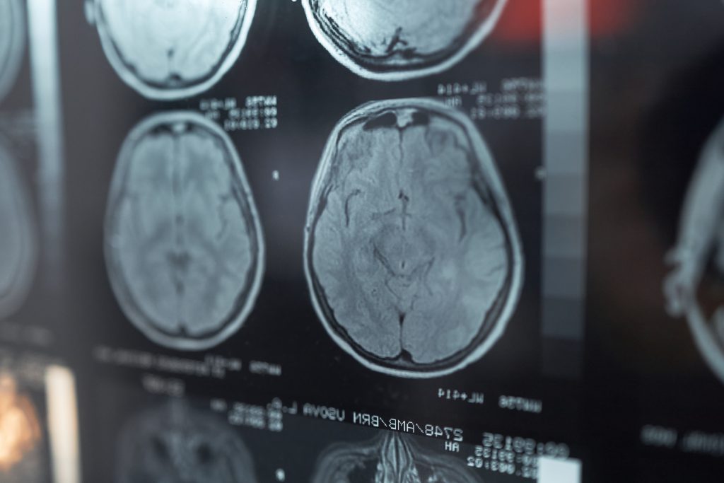 Intraventricular hemorrhage