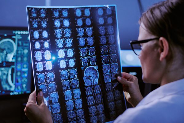 Oclusión de la arteria basilar: tratamiento de una emergencia neurológica 6 Oclusión de la arteria basilar