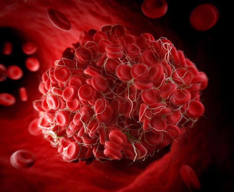 síndrome antifosfolípide