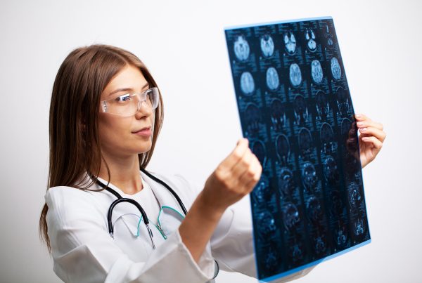 Cómo comienza un derrame cerebral y sus claves para entenderlo 11 How a stroke begins