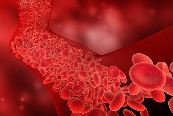 Deep Vein Thrombosis