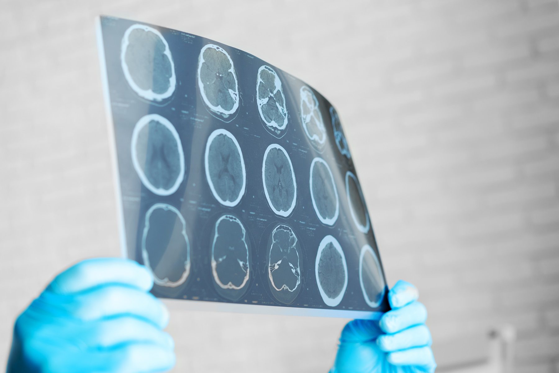 hemicraniectomia descompressiva