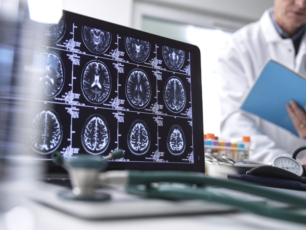 Ictus cardioembólico: causas y síntomas 2 ictus cardioembólico