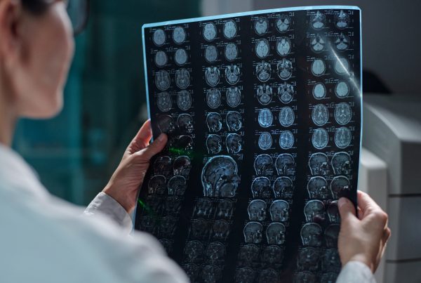infarto cerebral extenso