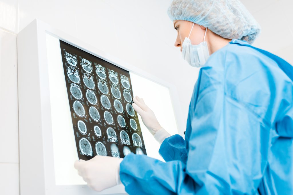 infarto de la arteria cerebral anterior