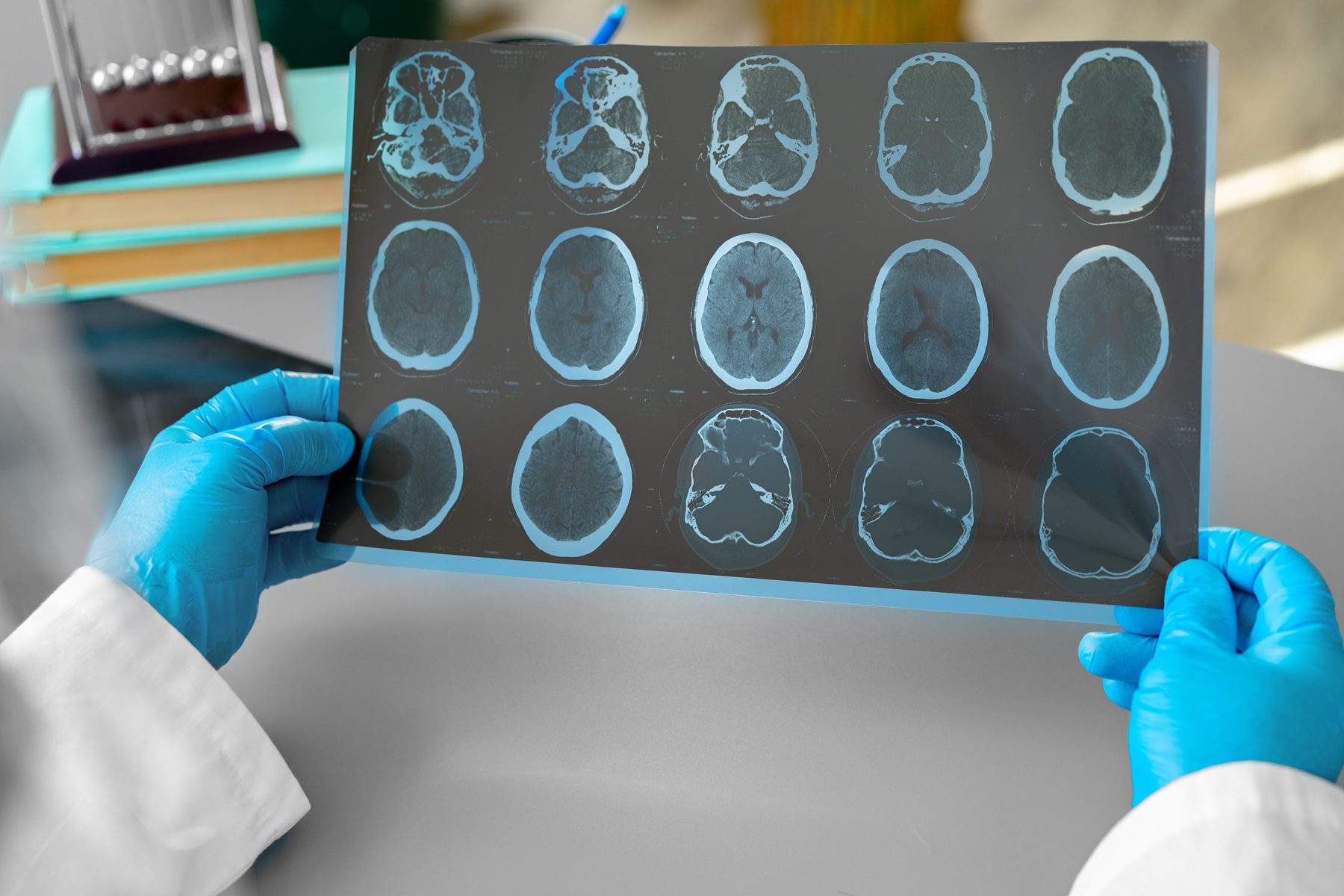 Sequelas do AVC: impacto, recuperação e reabilitação 3 equelas do AVC