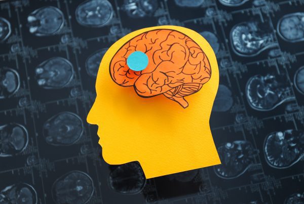 Edema citotóxico: el impacto silencioso en el cerebro tras un ACV 2 Cytotoxic edema