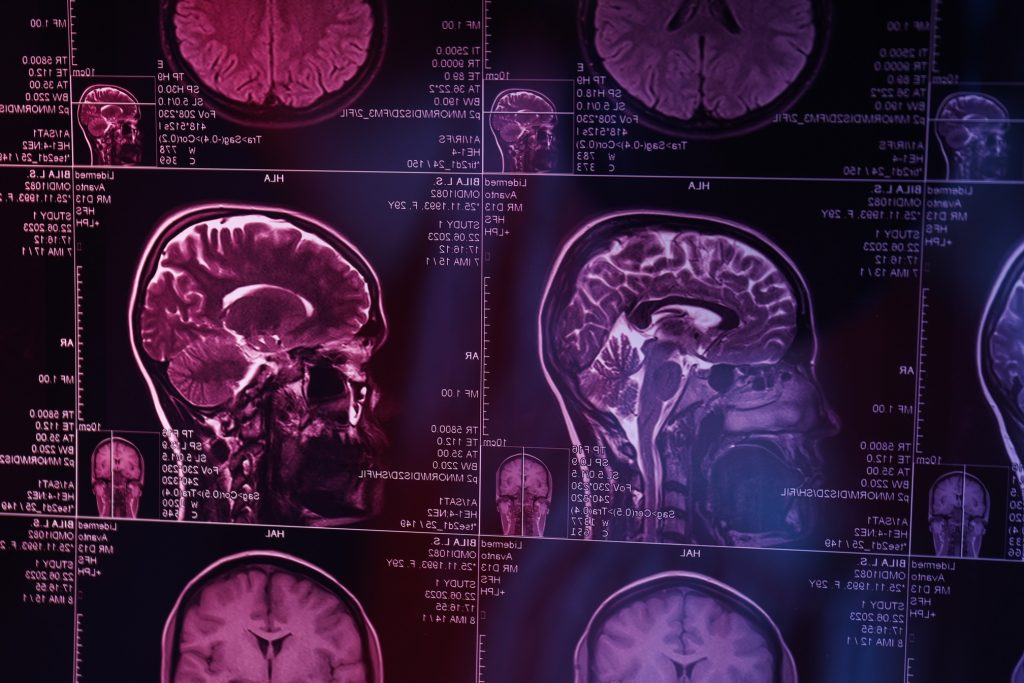 mri or magnetic resonance imaging of the head and 2023 11 27 05 01 21 utc 2