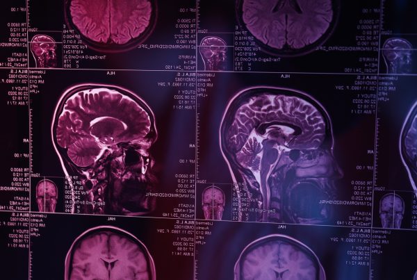 mri or magnetic resonance imaging of the head and 2023 11 27 05 01 21 utc 2