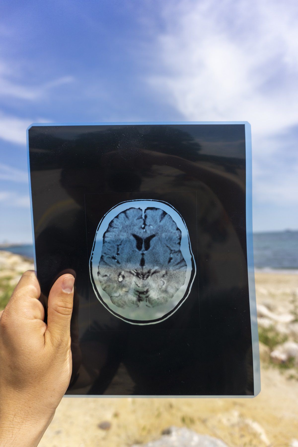 Hemianopsia homônima